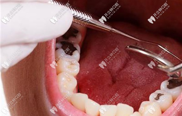 矯正牙齒期間容易長(zhǎng)蛀牙?這些治療和預(yù)防妙招送給你！