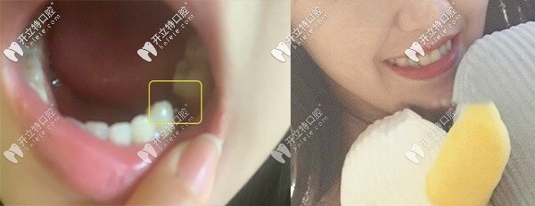 在昆明德韓口腔做韓系進(jìn)口種植牙的真實(shí)評(píng)價(jià)來(lái)了