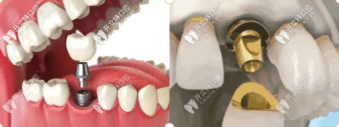 2025年種植牙集采價(jià)格下降