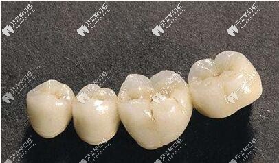 金屬烤瓷牙崩瓷 金屬烤瓷牙崩瓷