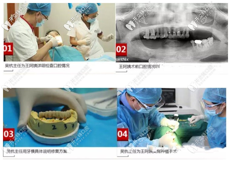 王阿姨做allon4半口種植牙的詳細(xì)過程