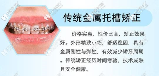 傳統(tǒng)金屬矯正器優(yōu)勢