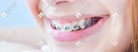 汕頭口碑好的華美口腔牙齒矯正價(jià)格上線，呼叫需整牙的你