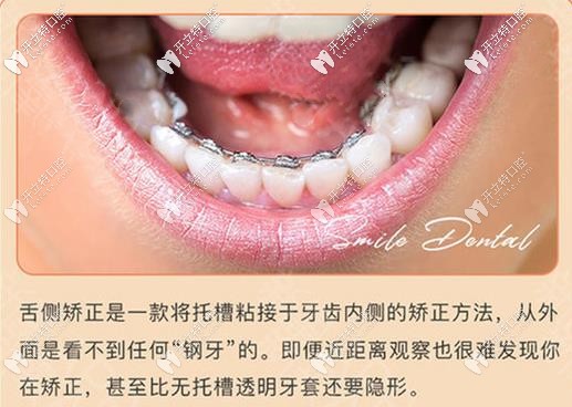 舌側(cè)隱形牙齒矯正好處