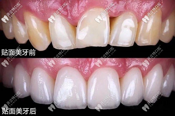 超薄瓷貼面修復(fù)前后效果