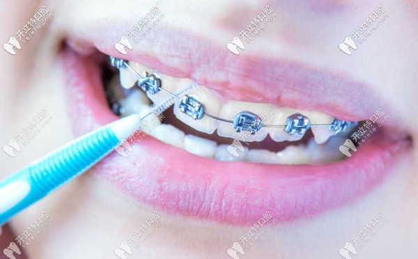 烏魯木齊做牙齒矯正的參考價格