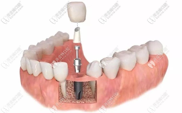 烏魯木齊做種植牙的參考價格