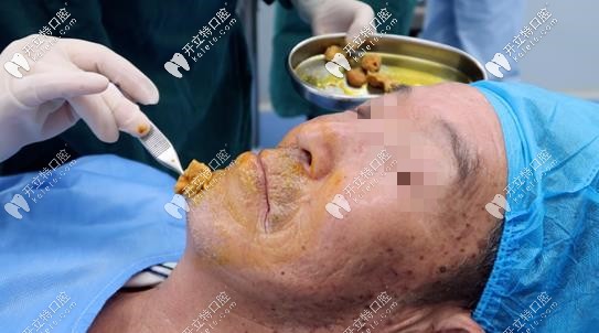 種植牙手術(shù)過程前消毒