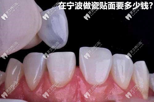 在寧波做瓷貼面的價(jià)格來(lái)咯