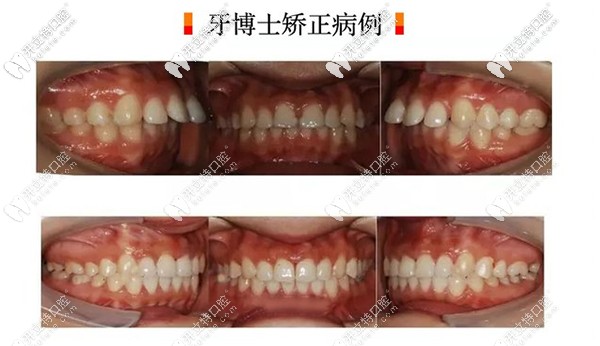 長春超龍牙博士口腔做瑞士進(jìn)口隱形矯正案例