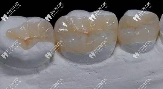 樹脂補(bǔ)牙的外觀