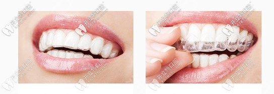 隱形矯正牙套 隱形矯正牙套