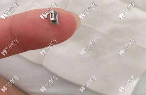 托槽掉了還能再用嗎，該如何處理？