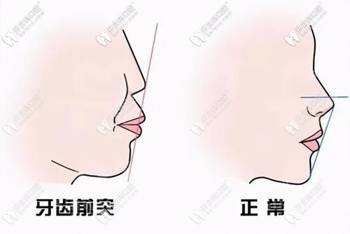 牙齒前突的來(lái)看看煙臺(tái)圣貝口腔矯正牙齒怎么樣