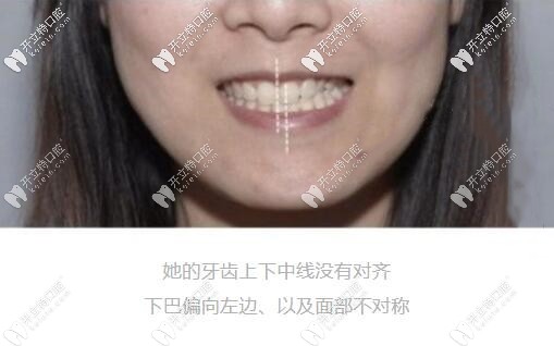 骨性偏頜一定要做正頜手術嗎?怎么判斷自己是骨性還是牙性