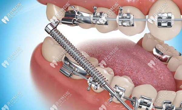 正畸托槽老是掉怎么辦，托槽掉了對(duì)矯正牙齒有影響嗎