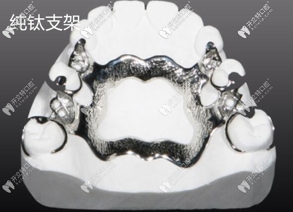 全口純鈦活動義齒