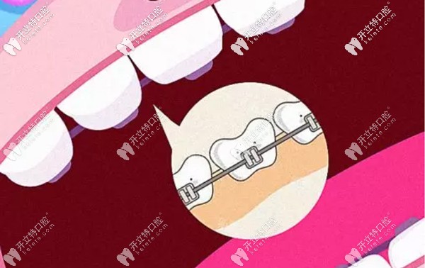 舌側(cè)隱形矯正的優(yōu)勢