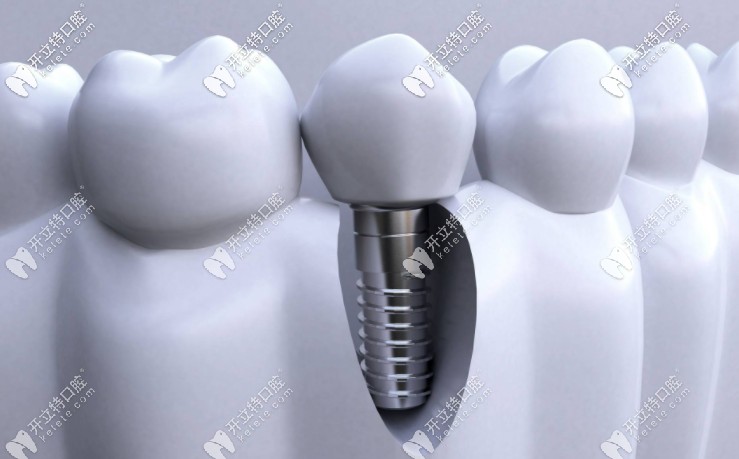 成都種植全口牙的價格是多少？附種牙醫(yī)生推薦！