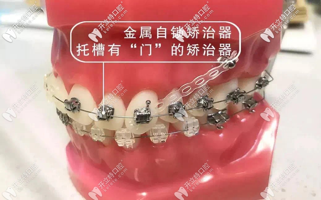 金屬自鎖牙套的解說