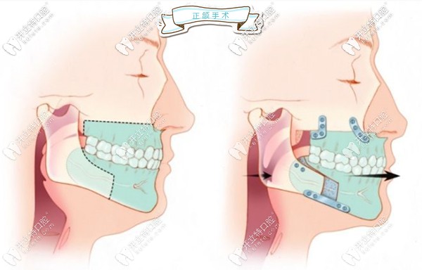 正頜手術(shù)示意圖