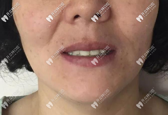 李女士做完種植的照片