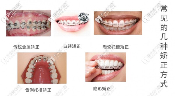 南寧做牙齒矯正的方法