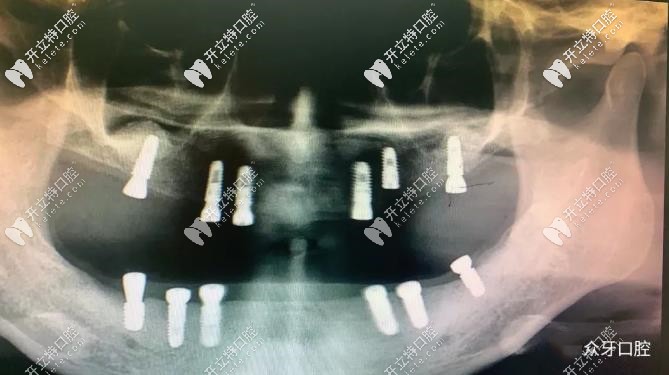 李女士做全口12顆種植牙的CT片