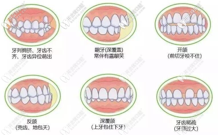 牙齒不齊的危害