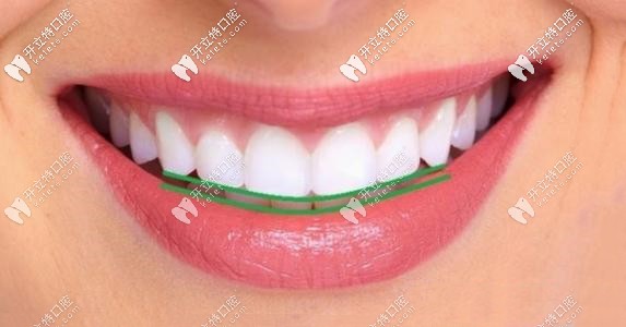 DSD美學(xué)微笑曲線設(shè)計(jì)