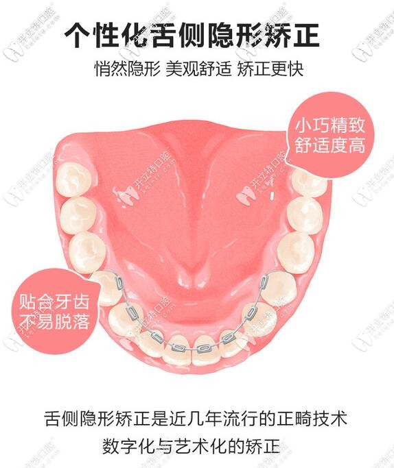 舌側(cè)隱形矯正的特點(diǎn)