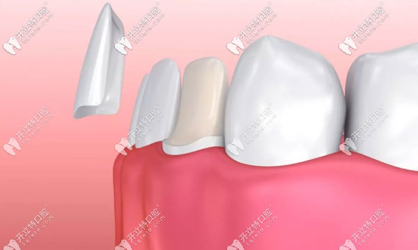 全瓷貼面?zhèn)溲懒可? border=