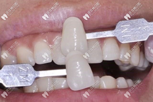 全瓷牙和真牙對比