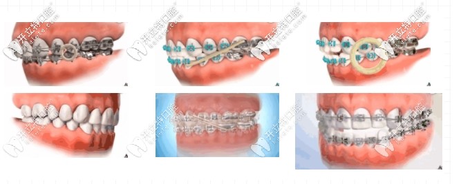 各種牙套牽引方式