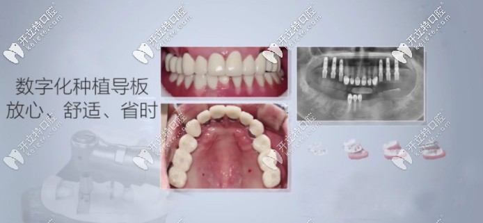 數(shù)字化導(dǎo)板種植