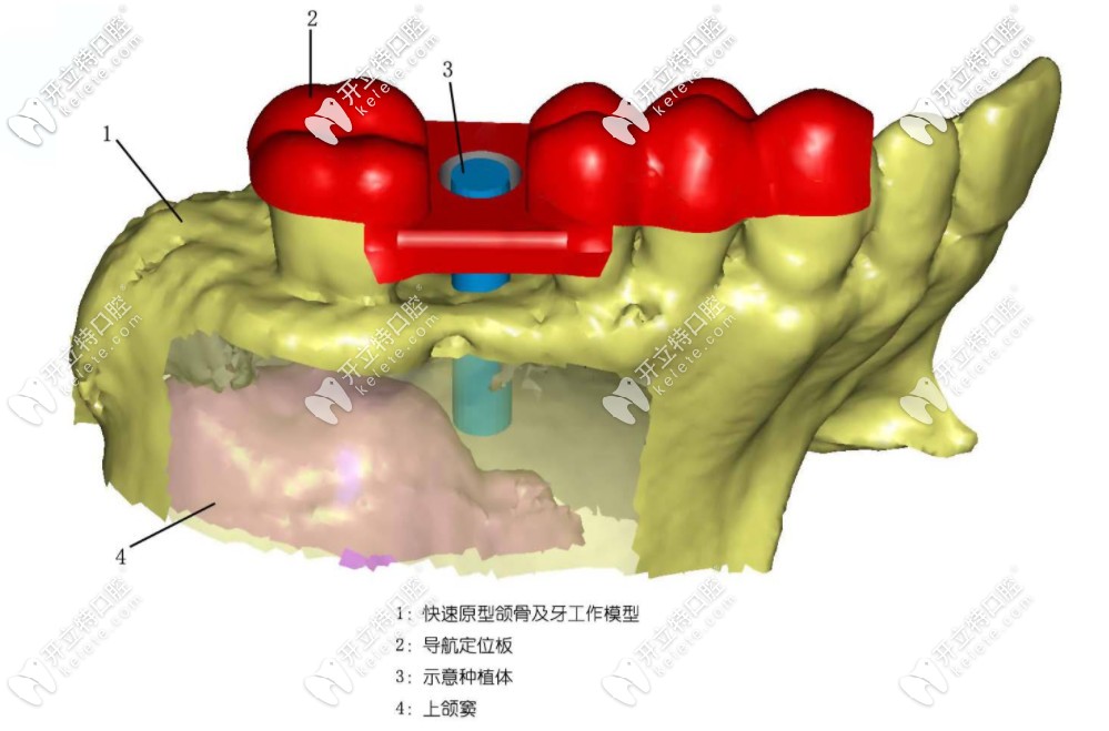 種牙為什么需要導板？導板種植牙與普通種植牙的區(qū)別在哪