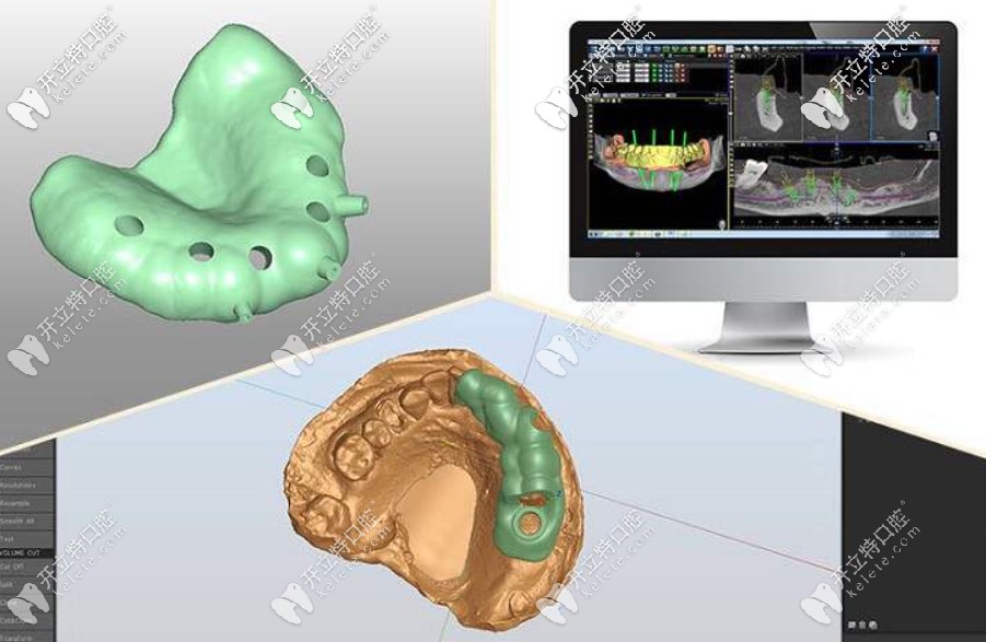 導(dǎo)板種植牙與普通種植牙的區(qū)別在哪