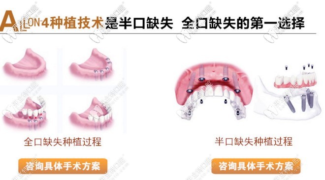 allon4即刻負(fù)重種植