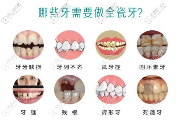 哪些牙齒需要做全瓷牙