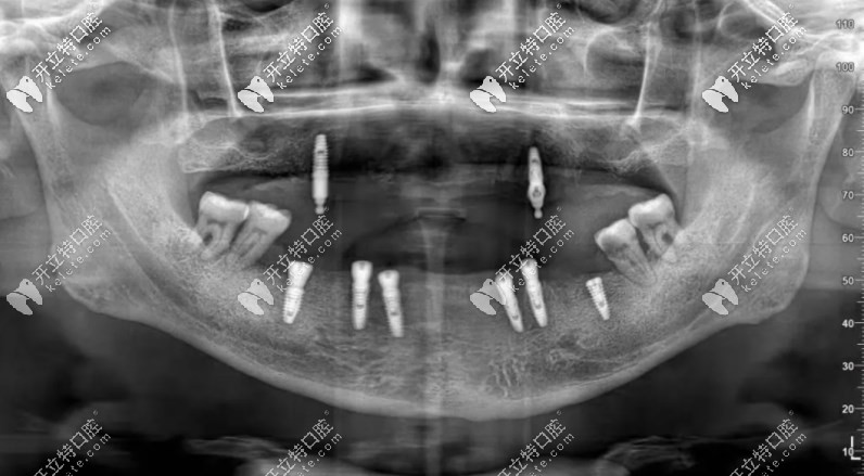 李叔叔種完牙拍的片子