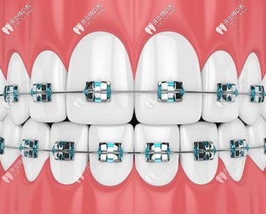 重慶惠城區(qū)的齊美口腔醫(yī)院做3m自鎖托槽矯正好不好？價(jià)格呢