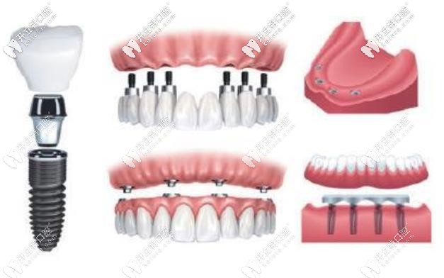 溫州市做全口種植牙價(jià)格是多少錢(qián)!上萬(wàn)的種植牙值得做嗎?
