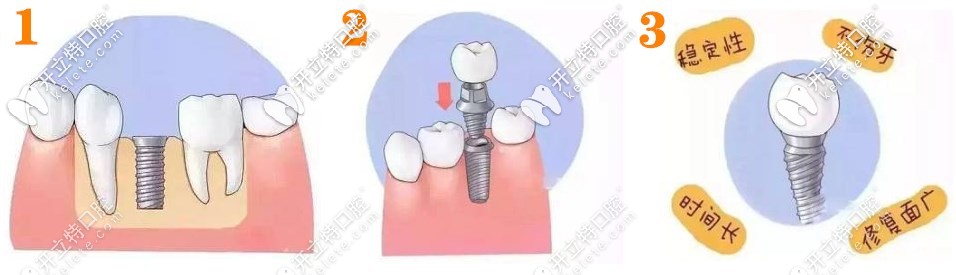 種植牙的簡單流程