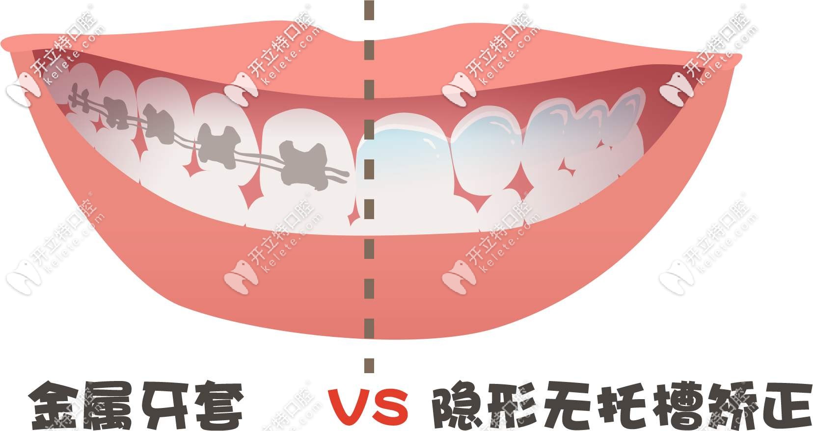 金屬牙套和隱形牙套圖示