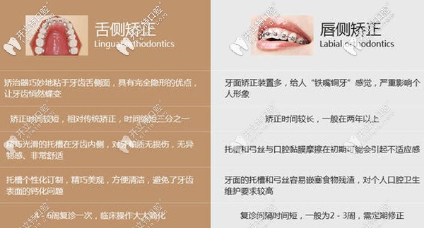舌側和唇側矯正的對比