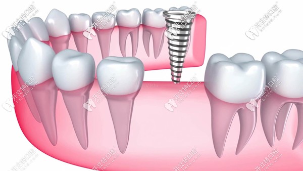 廣大口腔的德國和法國等種植牙價(jià)格