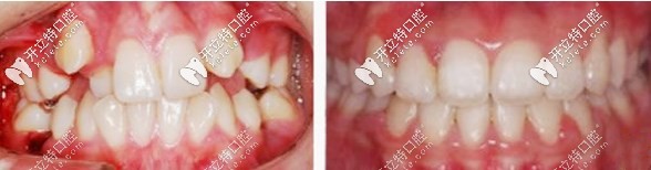 正畸前后對比