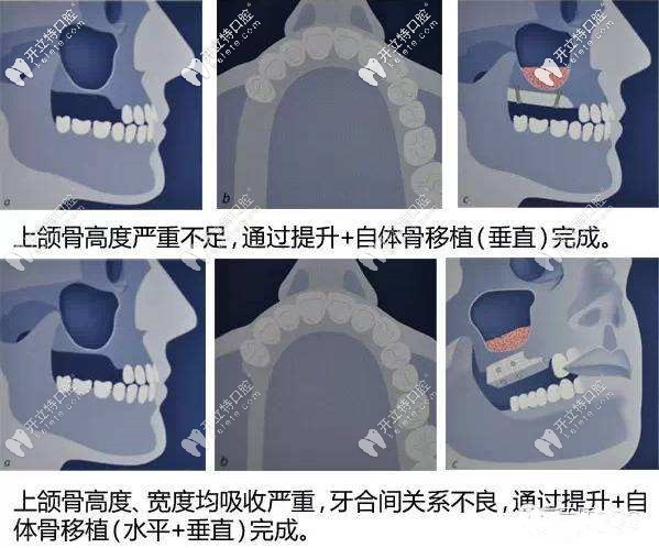 上頜竇內(nèi)外提升圖片