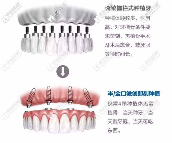 即刻負(fù)重種植牙