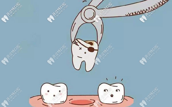 綜合類治療—拔牙費用